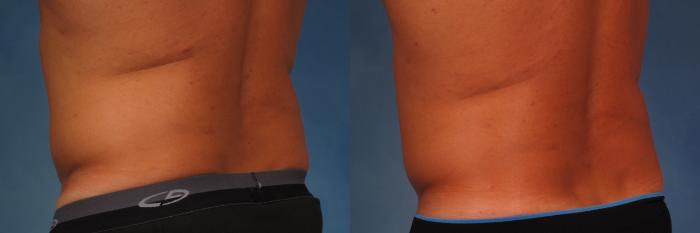 Before & After CoolSculpting Elite Case 212 View #2 View in Naples and Ft. Myers, FL
