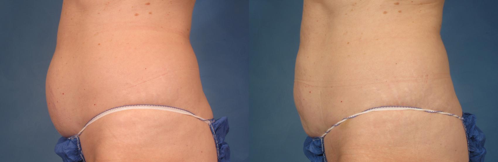 Before & After CoolSculpting® Elite Case 213 View #1 View in Naples and Ft. Myers, FL