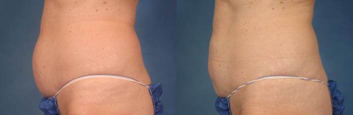 Before & After CoolSculpting® Elite Case 213 View #1 View in Naples and Ft. Myers, FL