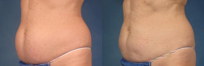 Before & After CoolSculpting® Elite Case 213 View #2 View in Naples and Ft. Myers, FL