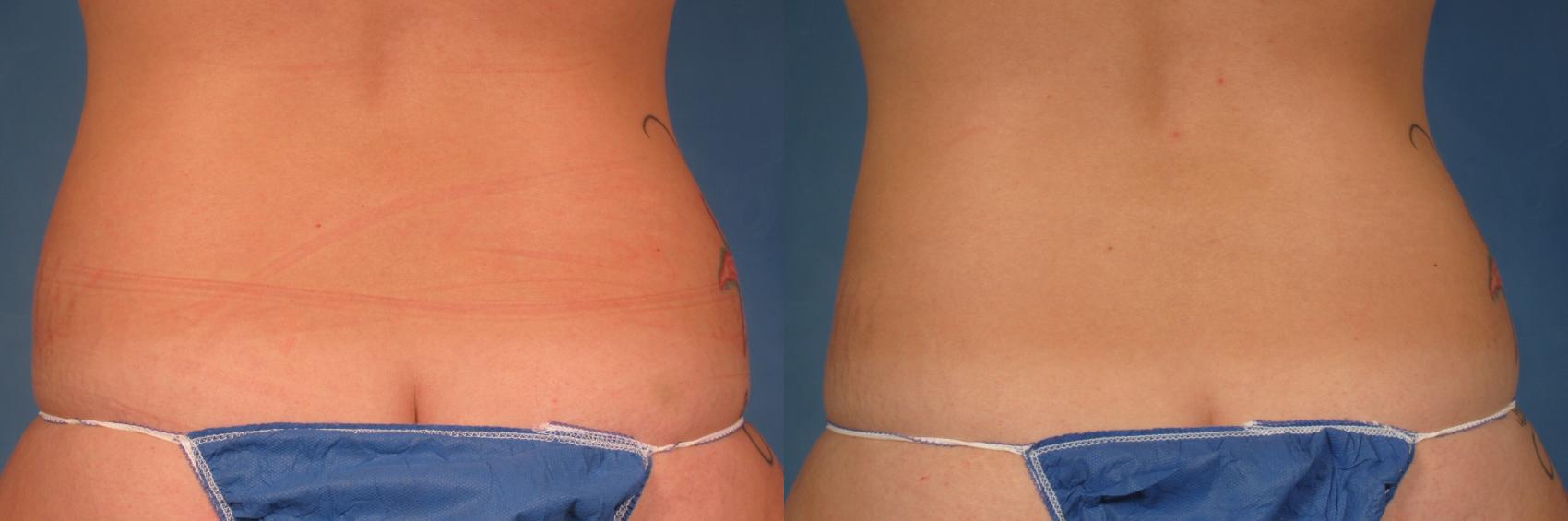 Before & After CoolSculpting® Elite Case 214 View #1 View in Naples and Ft. Myers, FL