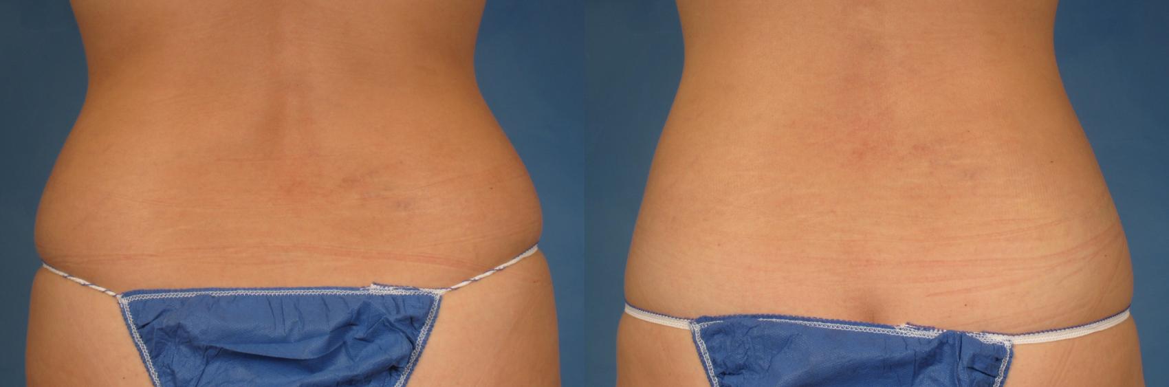 Before & After CoolSculpting Elite Case 215 View #1 View in Naples and Ft. Myers, FL