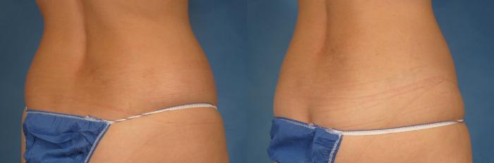Before & After CoolSculpting Elite Case 215 View #2 View in Naples and Ft. Myers, FL