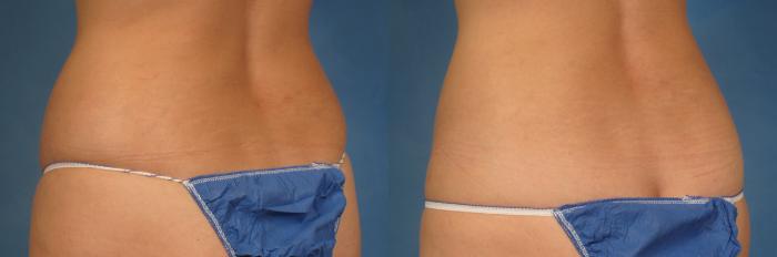 Before & After CoolSculpting Elite Case 215 View #3 View in Naples and Ft. Myers, FL
