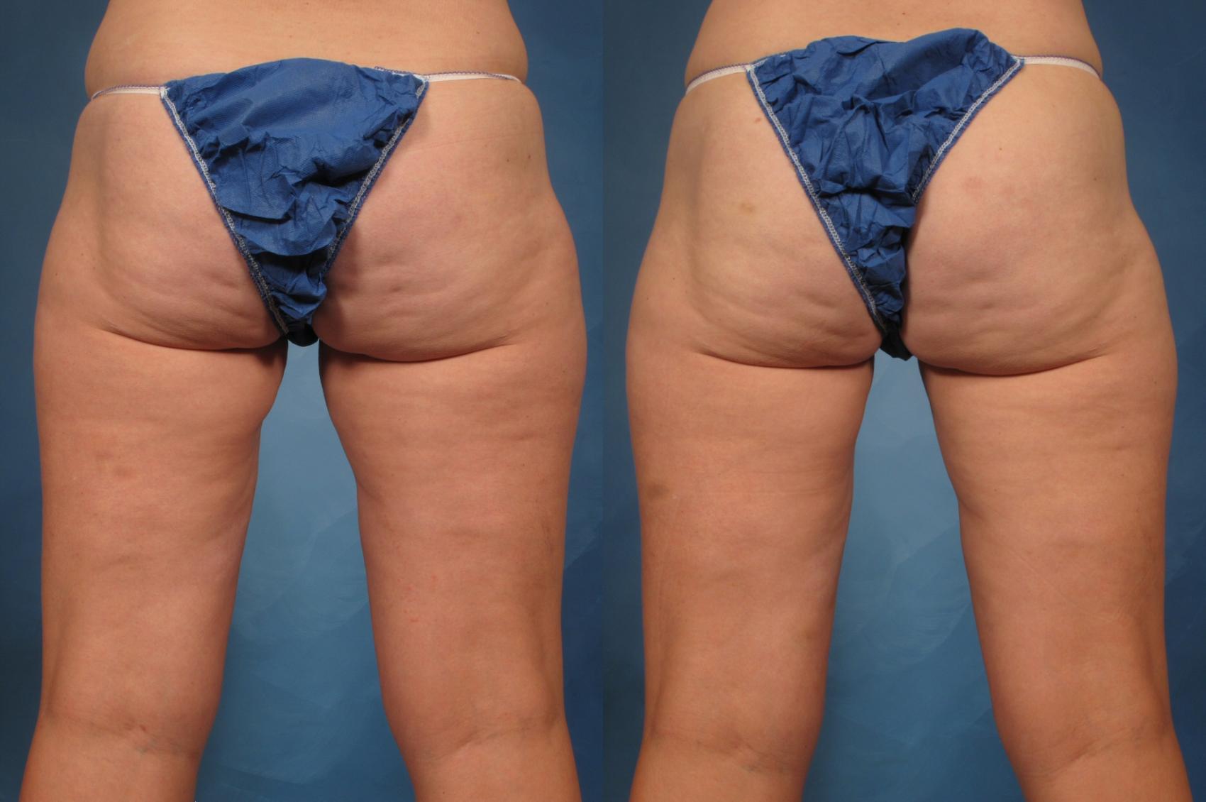 CoolSculpting Elite Before and After