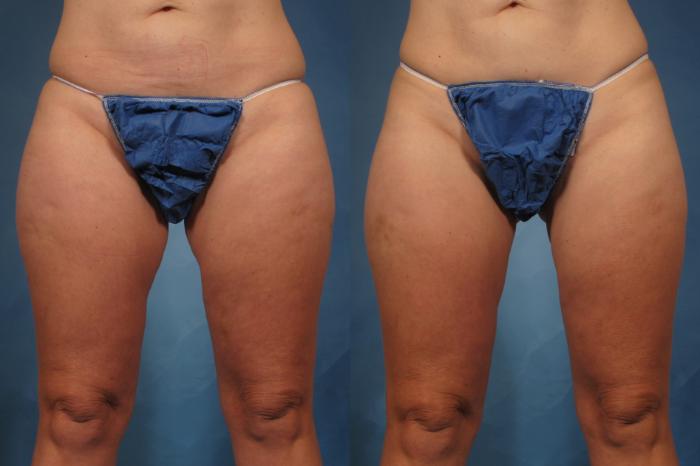 Before & After CoolSculpting Elite Case 222 View #2 View in Naples and Ft. Myers, FL