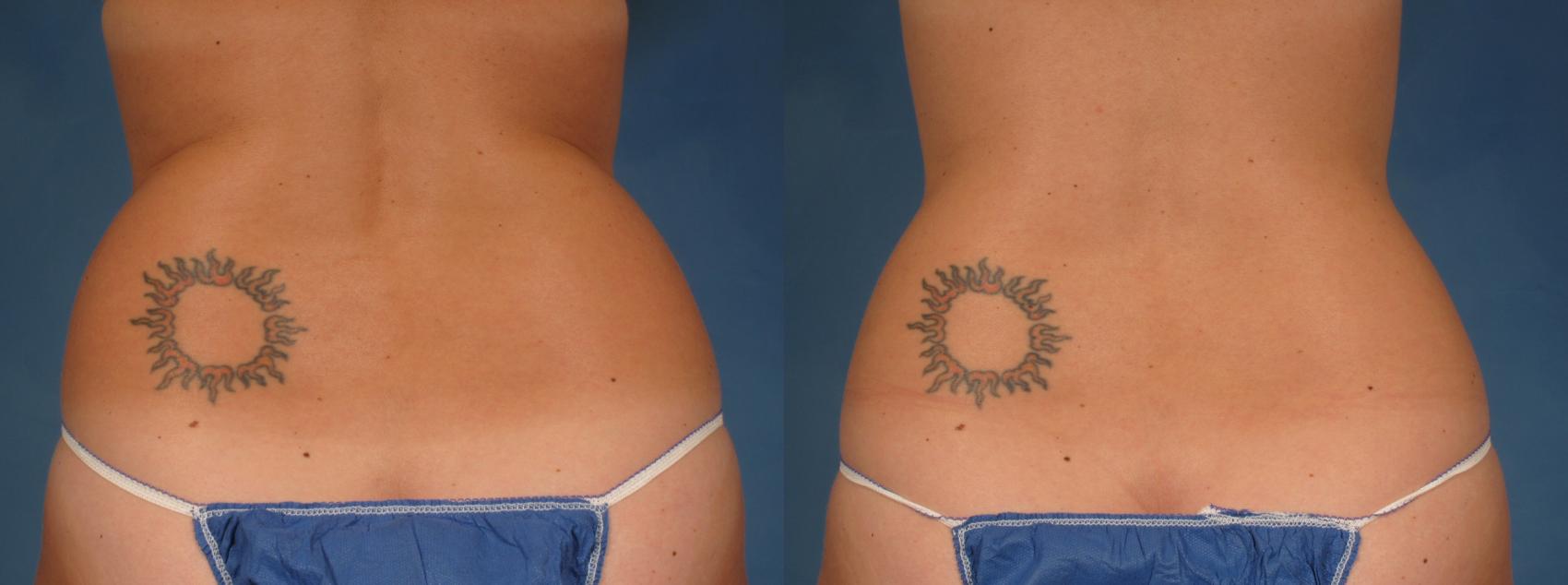 Before & After CoolSculpting® Elite Case 223 View #1 View in Naples and Ft. Myers, FL