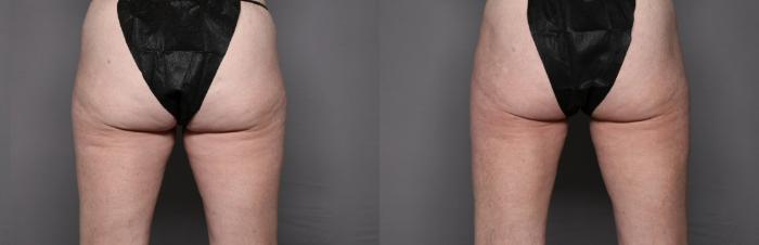 Before & After CoolSculpting Elite Case 457 Back View in Naples and Ft. Myers, FL