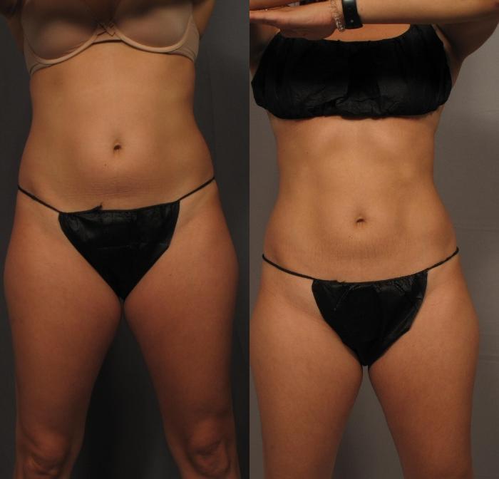 Before & After CoolSculpting Elite Case 458 Front View in Naples and Ft. Myers, FL