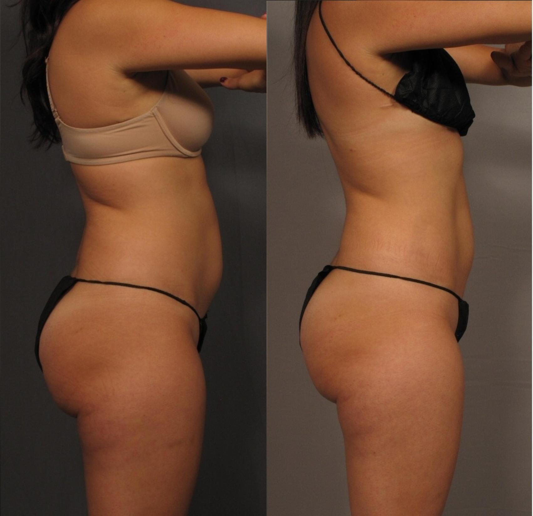 Before & After CoolSculpting Elite Case 458 Left Side View in Naples and Ft. Myers, FL