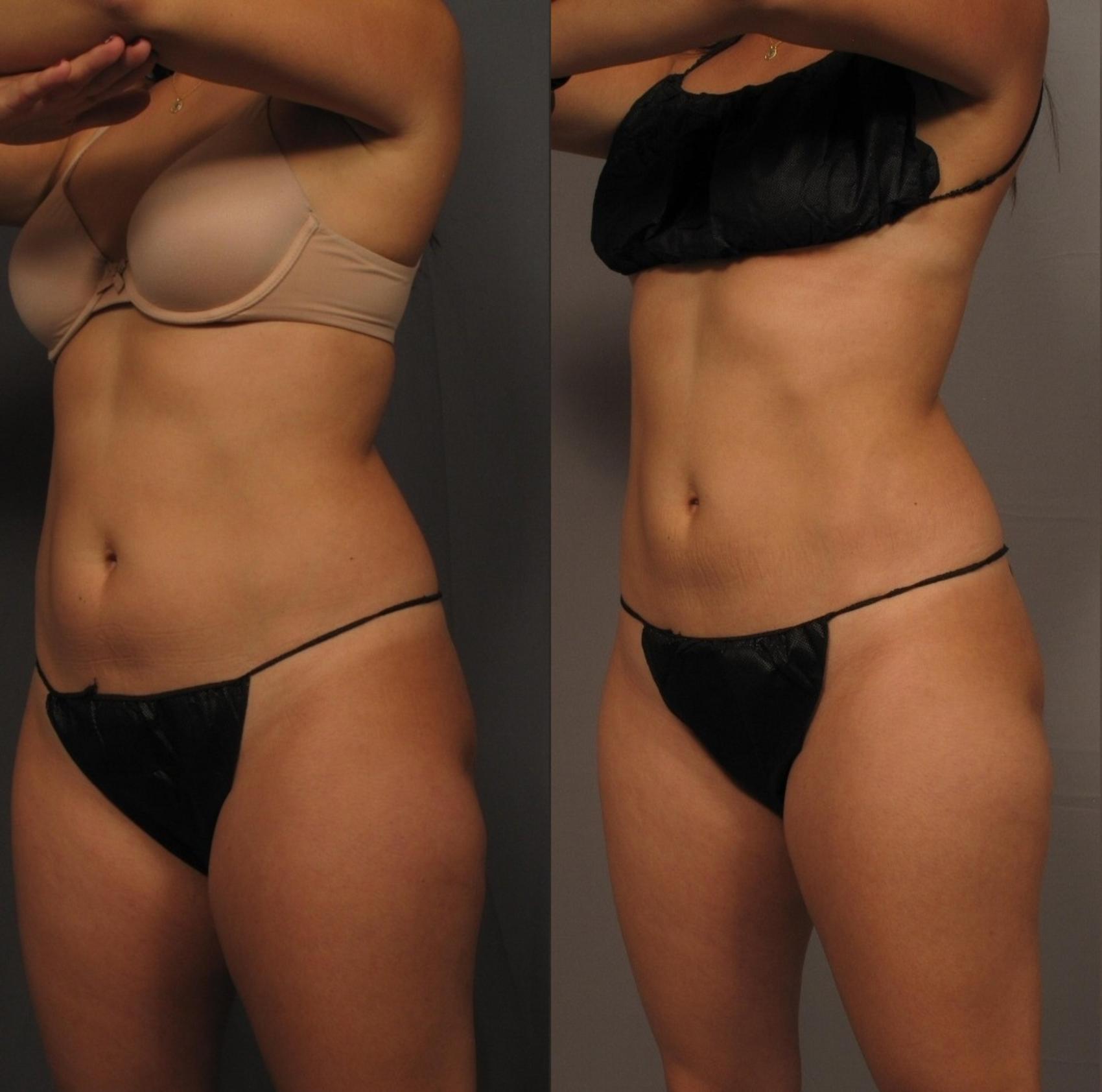 Before & After CoolSculpting Elite Case 458 Right Side View in Naples and Ft. Myers, FL