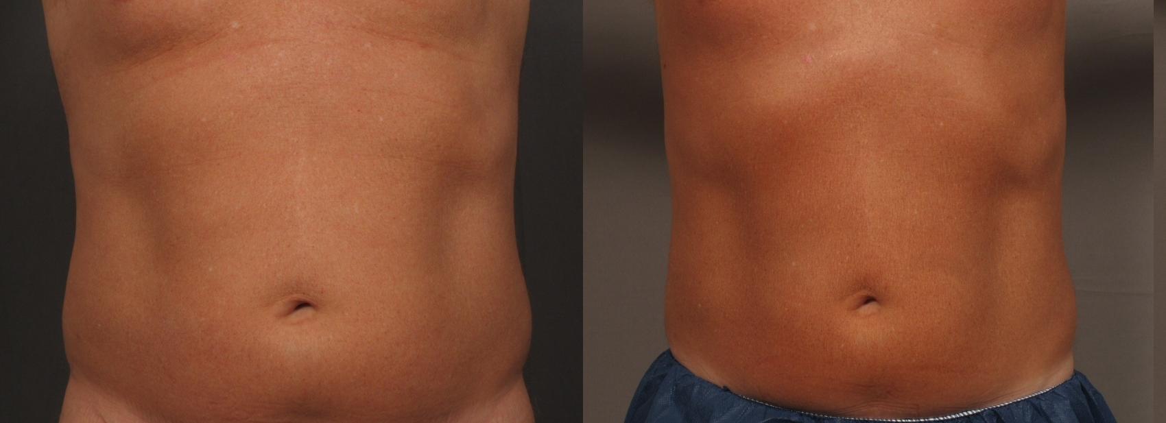 Before & After CoolSculpting Elite Case 459 Front View in Naples and Ft. Myers, FL