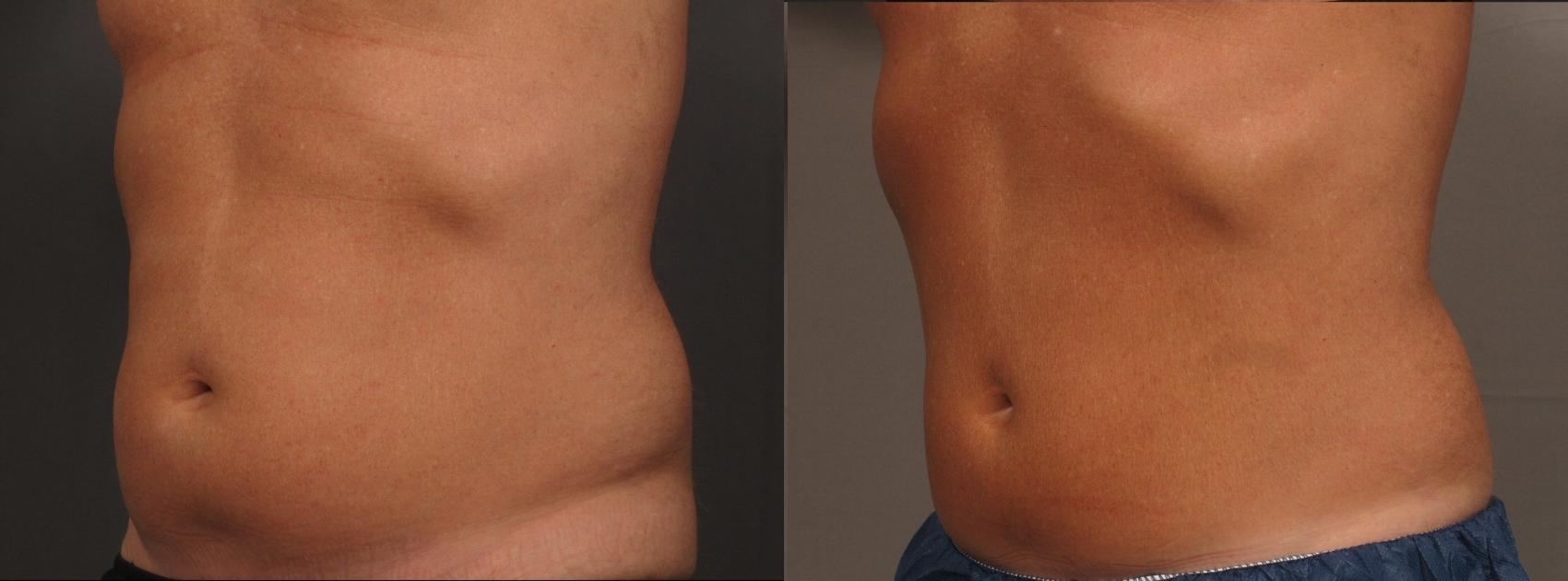Before & After CoolSculpting Elite Case 459 Left Side View in Naples and Ft. Myers, FL