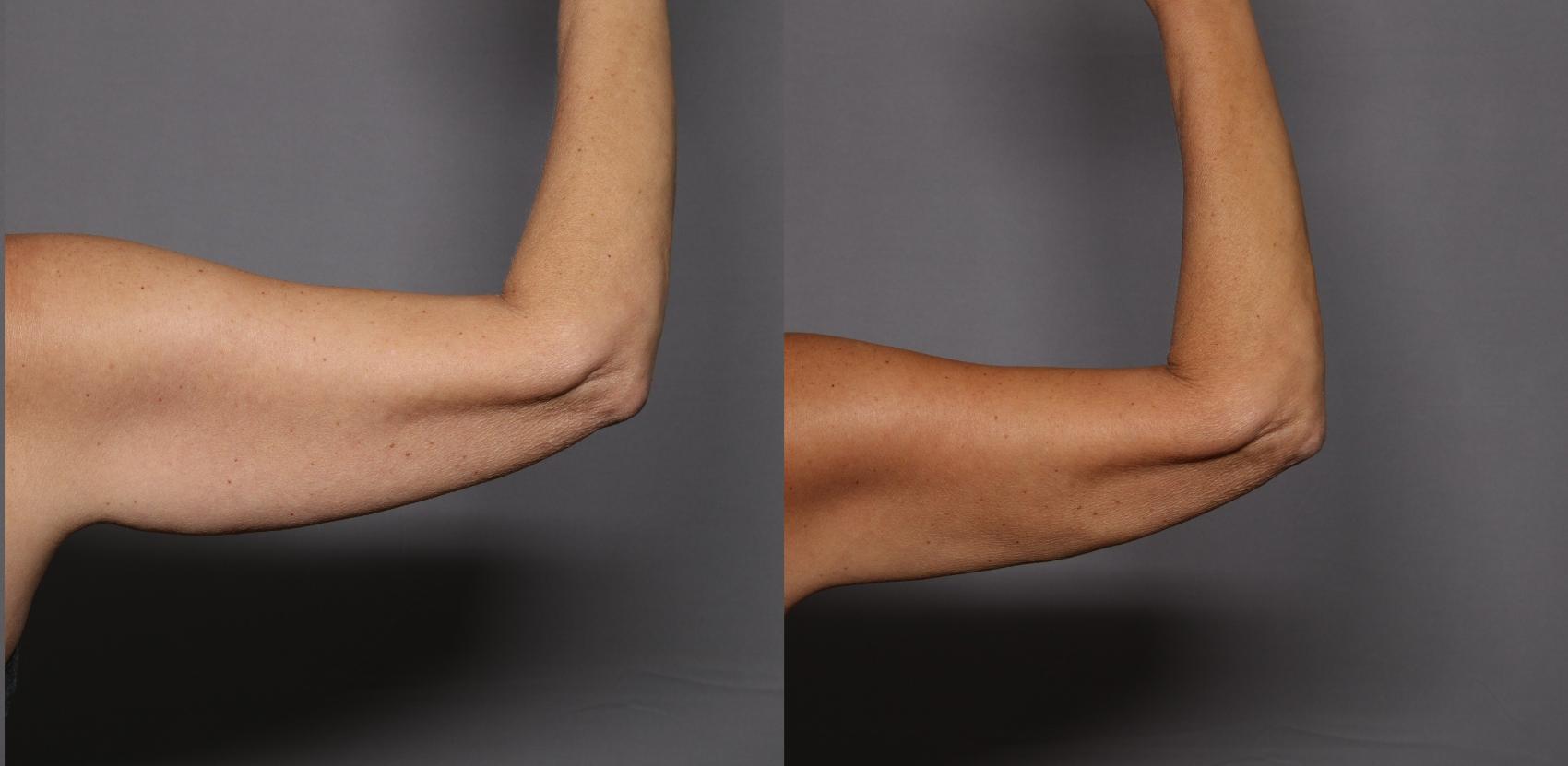 Before & After CoolSculpting Elite Case 460 Back View in Naples and Ft. Myers, FL