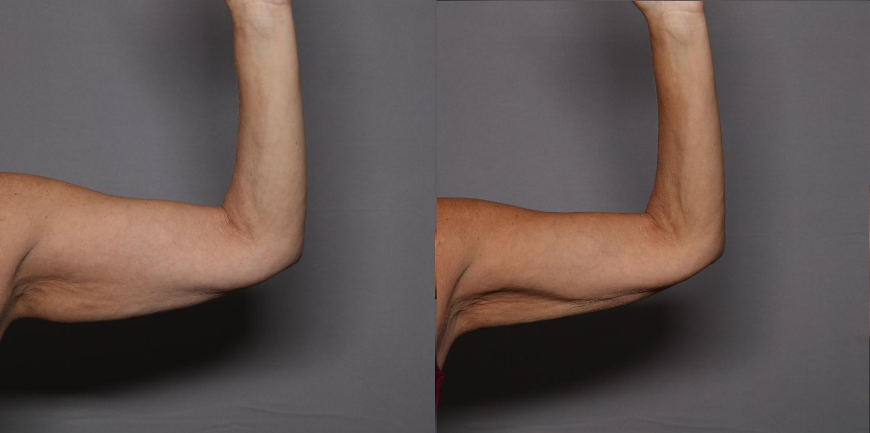 Before & After CoolSculpting Elite Case 460 Left Side View in Naples and Ft. Myers, FL