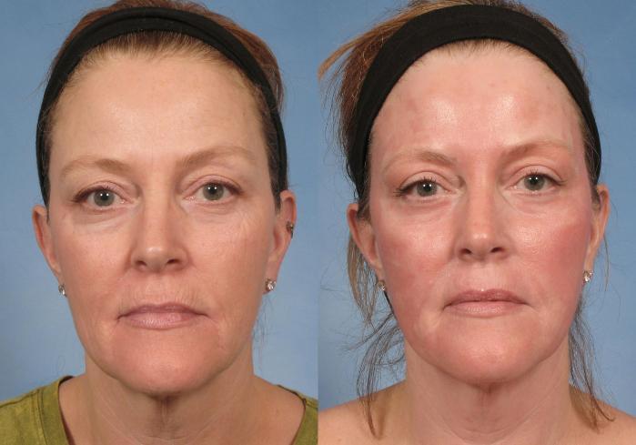 Before & After Croton Oil Peel Case 103 View #1 View in Naples and Ft. Myers, FL