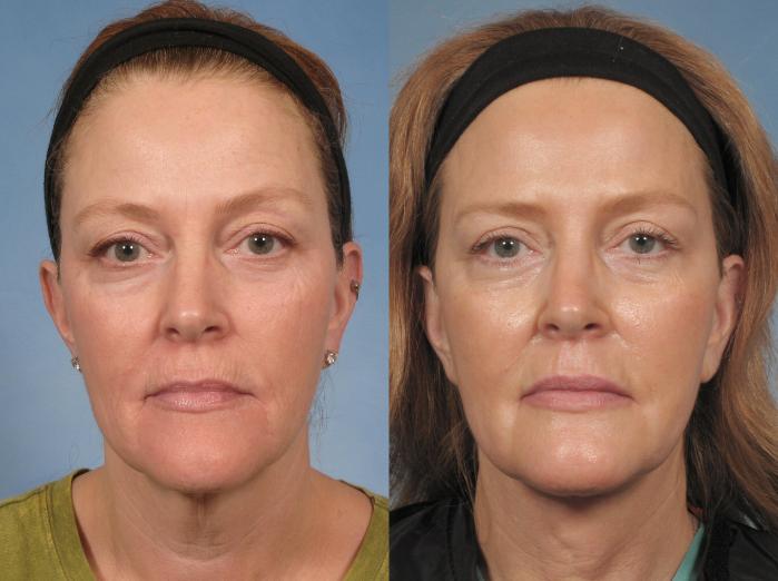 Before & After Croton Oil Peel Case 103 View #2 View in Naples and Ft. Myers, FL