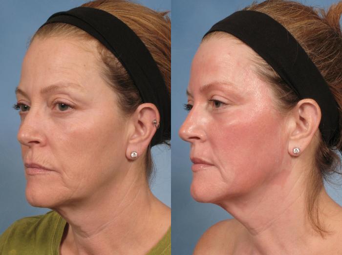 Before & After Croton Oil Peel Case 103 View #3 View in Naples and Ft. Myers, FL