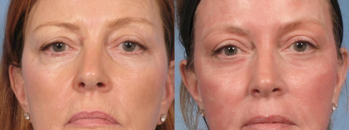 Before & After Croton Oil Peel Case 103 View #4 View in Naples and Ft. Myers, FL