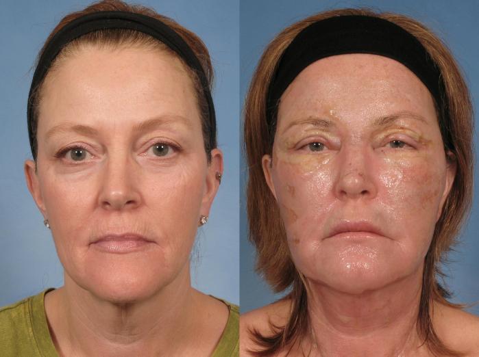Before & After Croton Oil Peel Case 103 View #6 View in Naples and Ft. Myers, FL