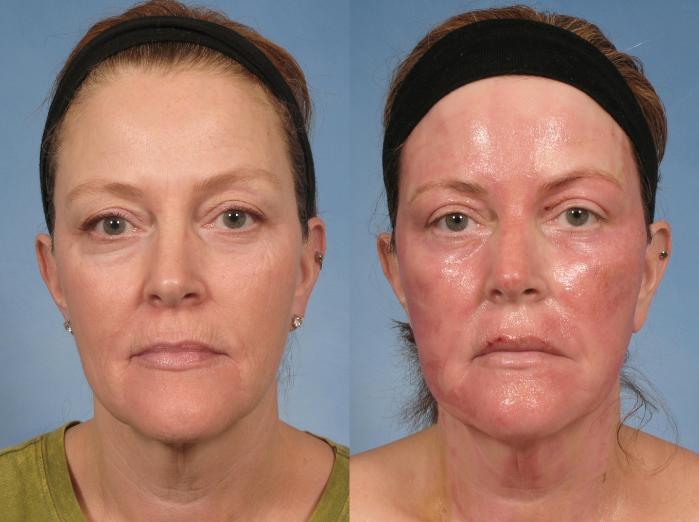 Before & After Croton Oil Peel Case 103 View #7 View in Naples and Ft. Myers, FL