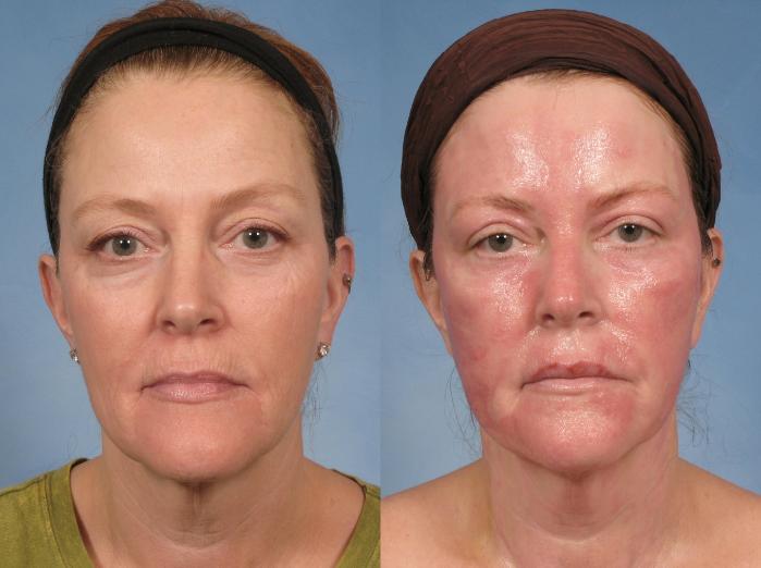 Before & After Croton Oil Peel Case 103 View #8 View in Naples and Ft. Myers, FL