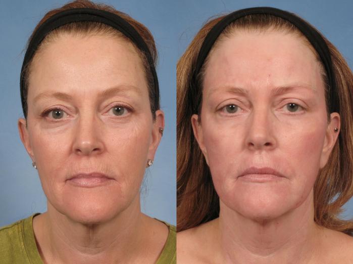 Before & After Croton Oil Peel Case 103 View #9 View in Naples and Ft. Myers, FL