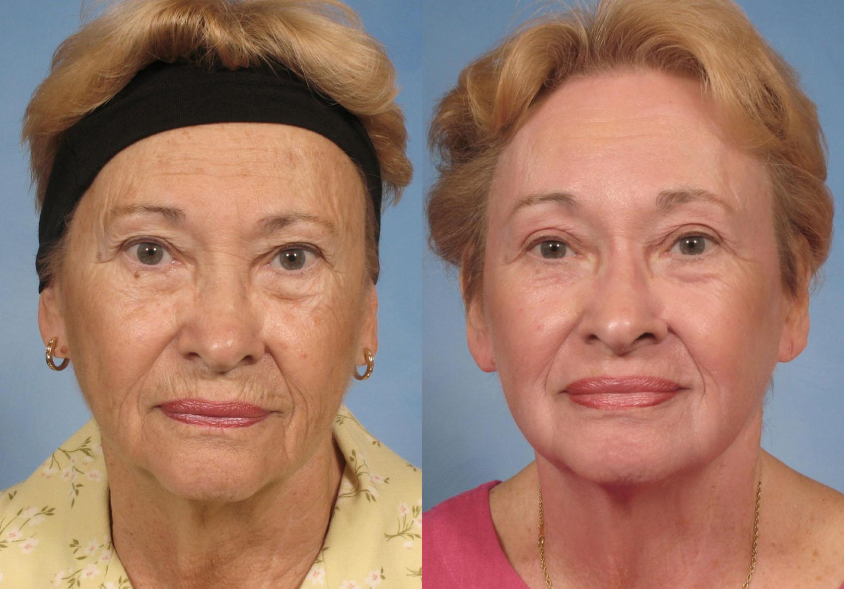 Before & After Croton Oil Peel Case 123 View #2 View in Naples and Ft. Myers, FL