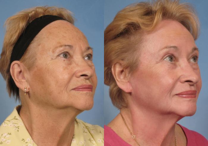 Before & After Croton Oil Peel Case 123 View #3 View in Naples and Ft. Myers, FL