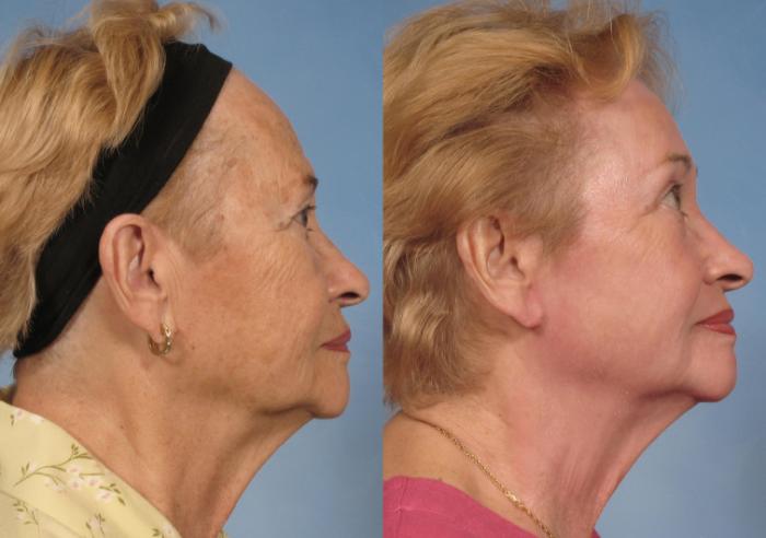 Before & After Croton Oil Peel Case 123 View #4 View in Naples and Ft. Myers, FL