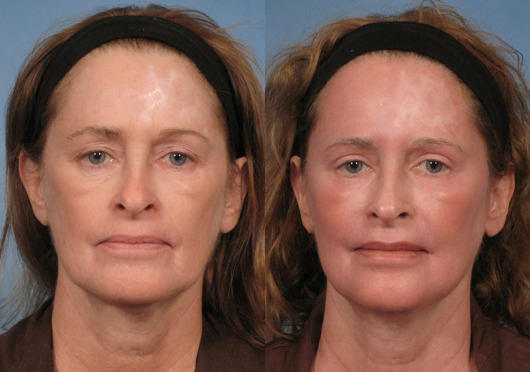 Before & After Croton Oil Peel Case 124 View #1 View in Naples and Ft. Myers, FL
