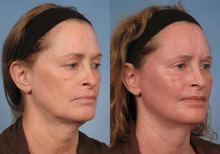Croton Oil Peel Before and After Pictures Case 124 | Naples and Ft. Myers,  FL | Kent V. Hasen, MD: Aesthetic Plastic Surgery & Med Spa of Naples