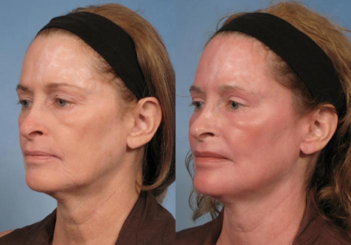 Before & After Croton Oil Peel Case 124 View #3 View in Naples and Ft. Myers, FL