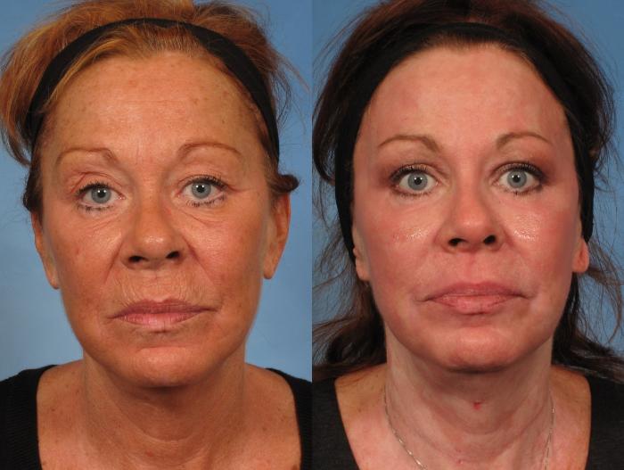 Before & After Croton Oil Peel Case 151 View #1 View in Naples and Ft. Myers, FL