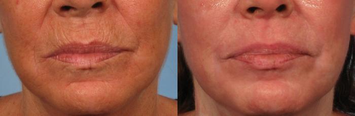Before & After Croton Oil Peel Case 151 View #2 View in Naples and Ft. Myers, FL