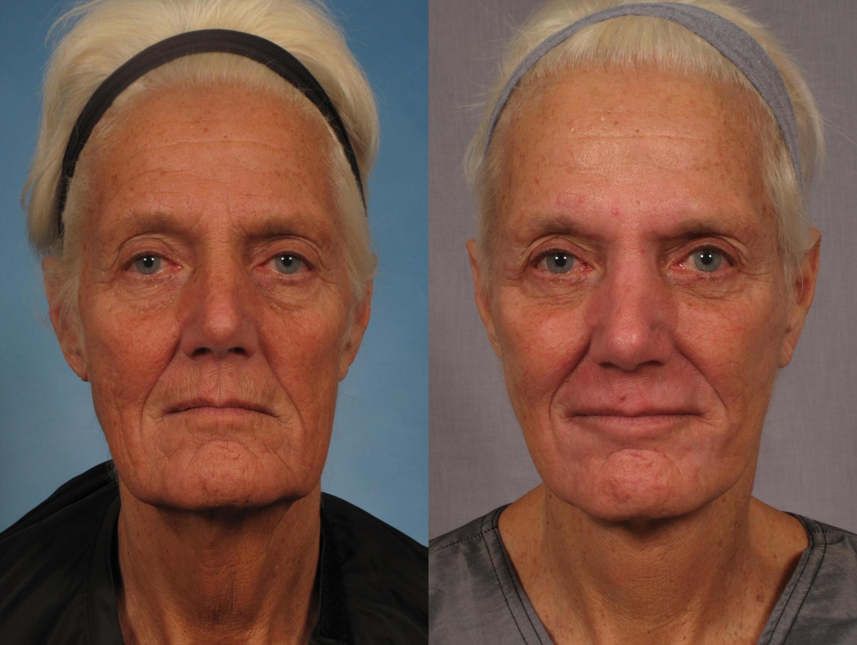 Before & After Croton Oil Peel Case 289 View #1 View in Naples and Ft. Myers, FL