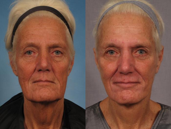 Before & After Croton Oil Peel Case 289 View #1 View in Naples and Ft. Myers, FL