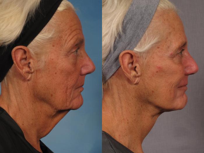 Before & After Croton Oil Peel Case 289 View #2 View in Naples and Ft. Myers, FL