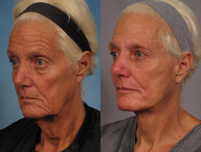 Before & After Croton Oil Peel Case 289 View #3 View in Naples and Ft. Myers, FL