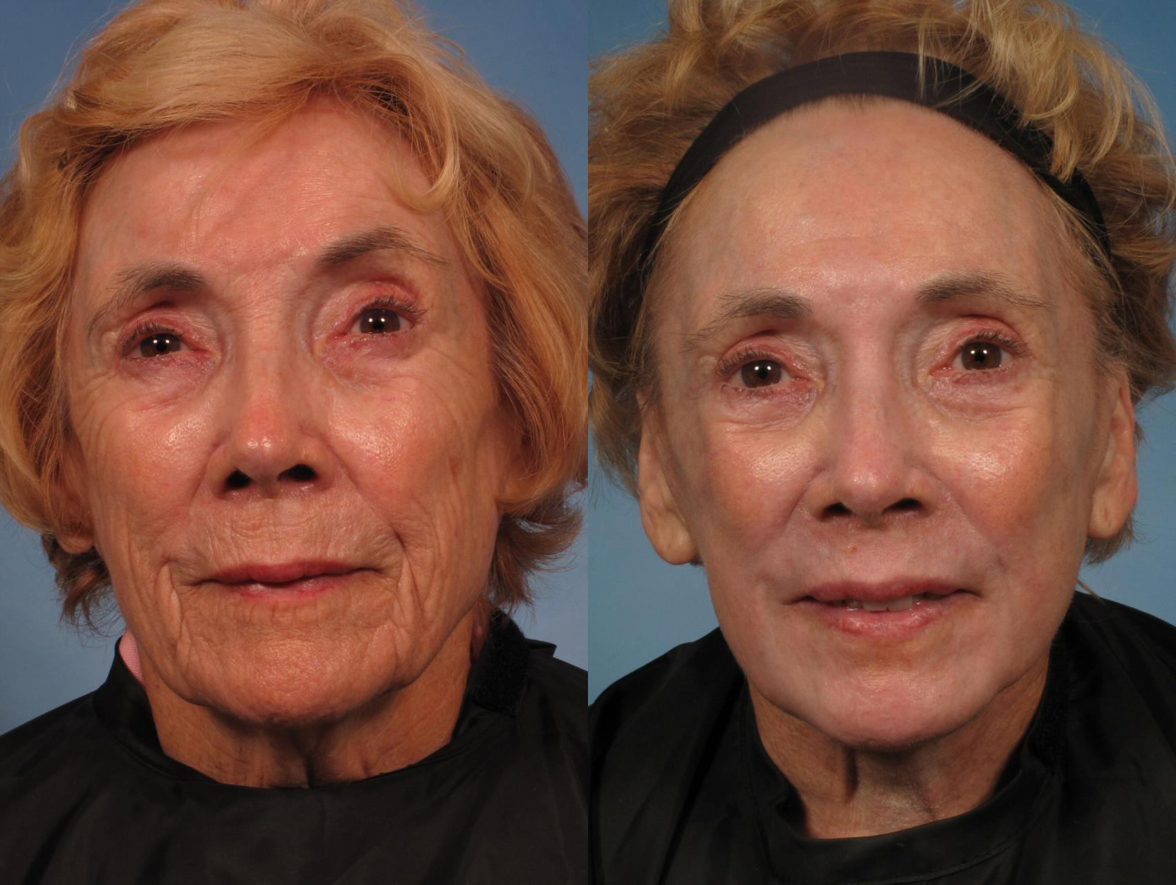 Before & After Croton Oil Peel Case 290 View #1 View in Naples and Ft. Myers, FL