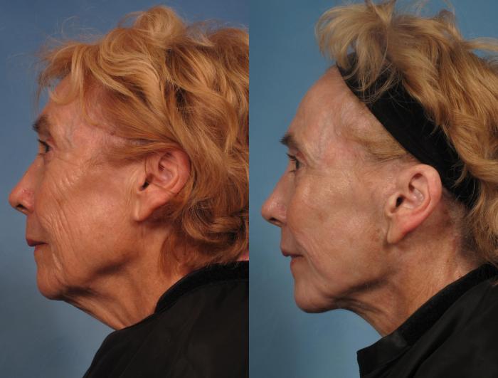 Before & After Croton Oil Peel Case 290 View #2 View in Naples and Ft. Myers, FL