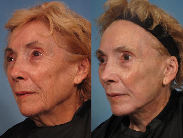 Before & After Croton Oil Peel Case 290 View #3 View in Naples and Ft. Myers, FL
