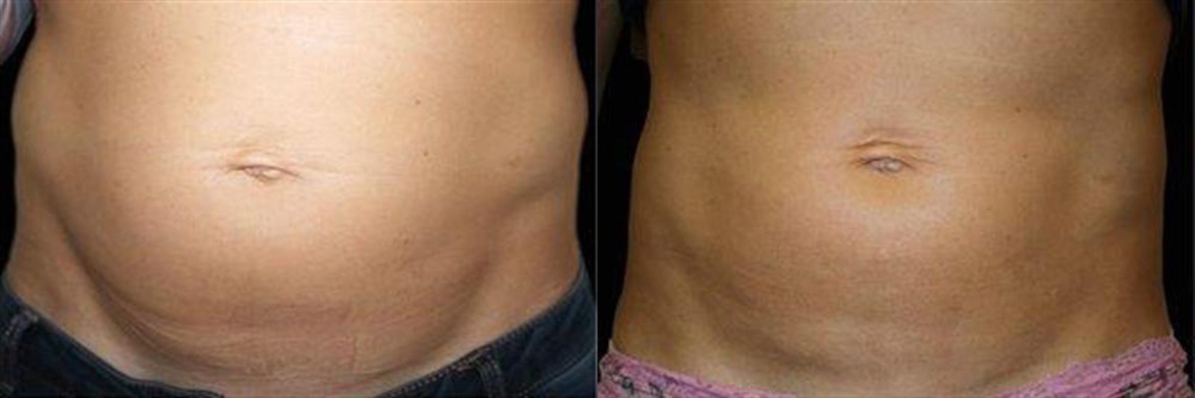 Before & After EMSCULPT NEO Case 351 View #1 View in Naples, FL