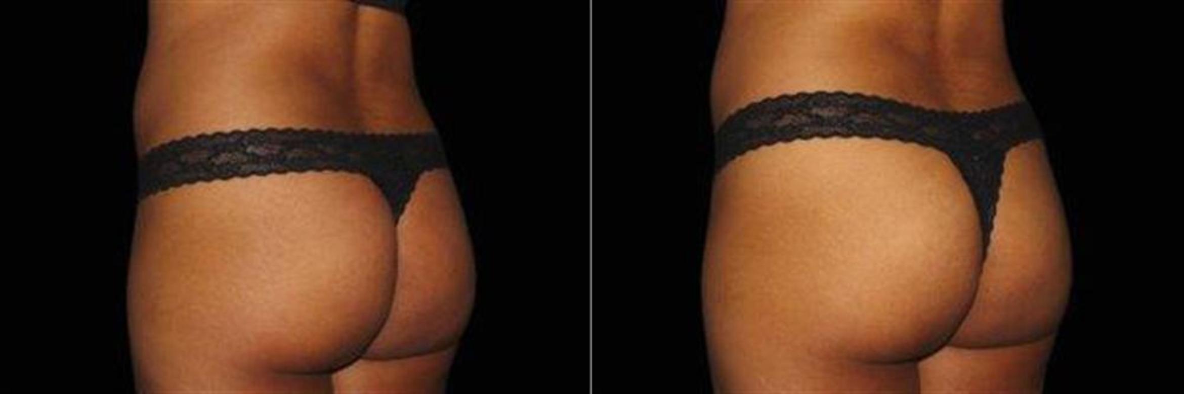 Before & After EMSCULPT NEO Case 354 View #1 View in Naples, FL
