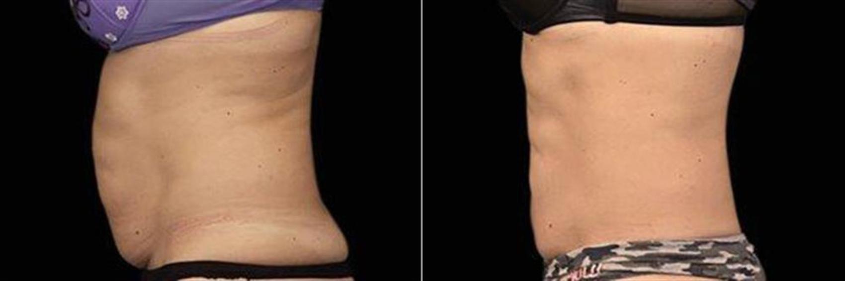 Before & After EMSCULPT NEO Case 345 View #1 View in Naples and Ft. Myers, FL