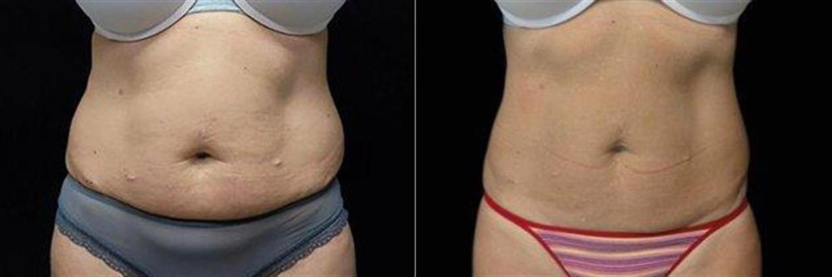 Before & After EMSCULPT NEO Case 347 View #1 View in Naples and Ft. Myers, FL