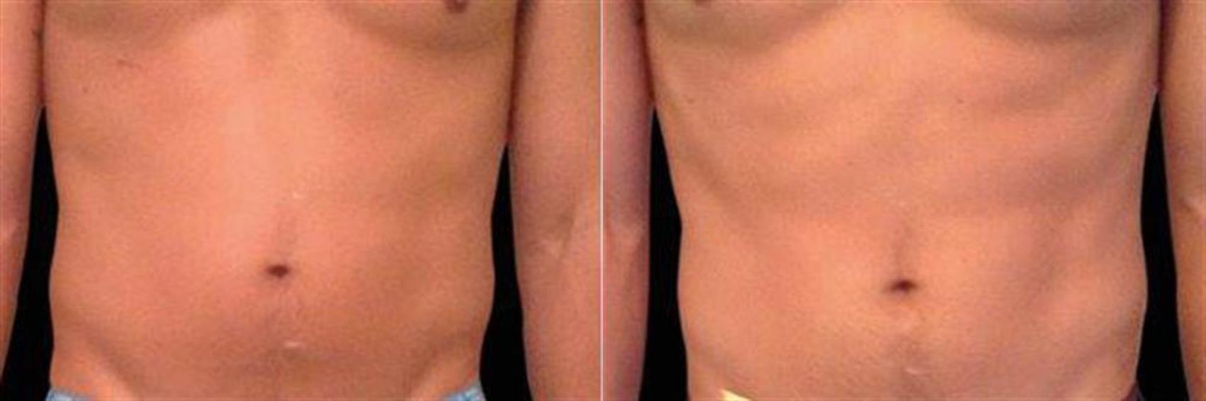 Before & After EMSCULPT NEO Case 348 View #1 View in Naples and Ft. Myers, FL