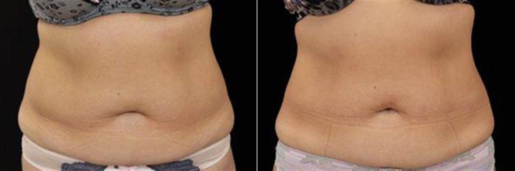 Before & After EMSCULPT NEO Case 350 View #1 View in Naples and Ft. Myers, FL
