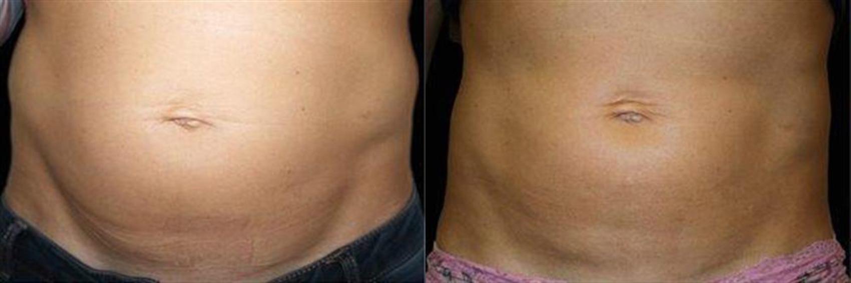 Before & After EMSCULPT NEO Case 351 View #1 View in Naples and Ft. Myers, FL