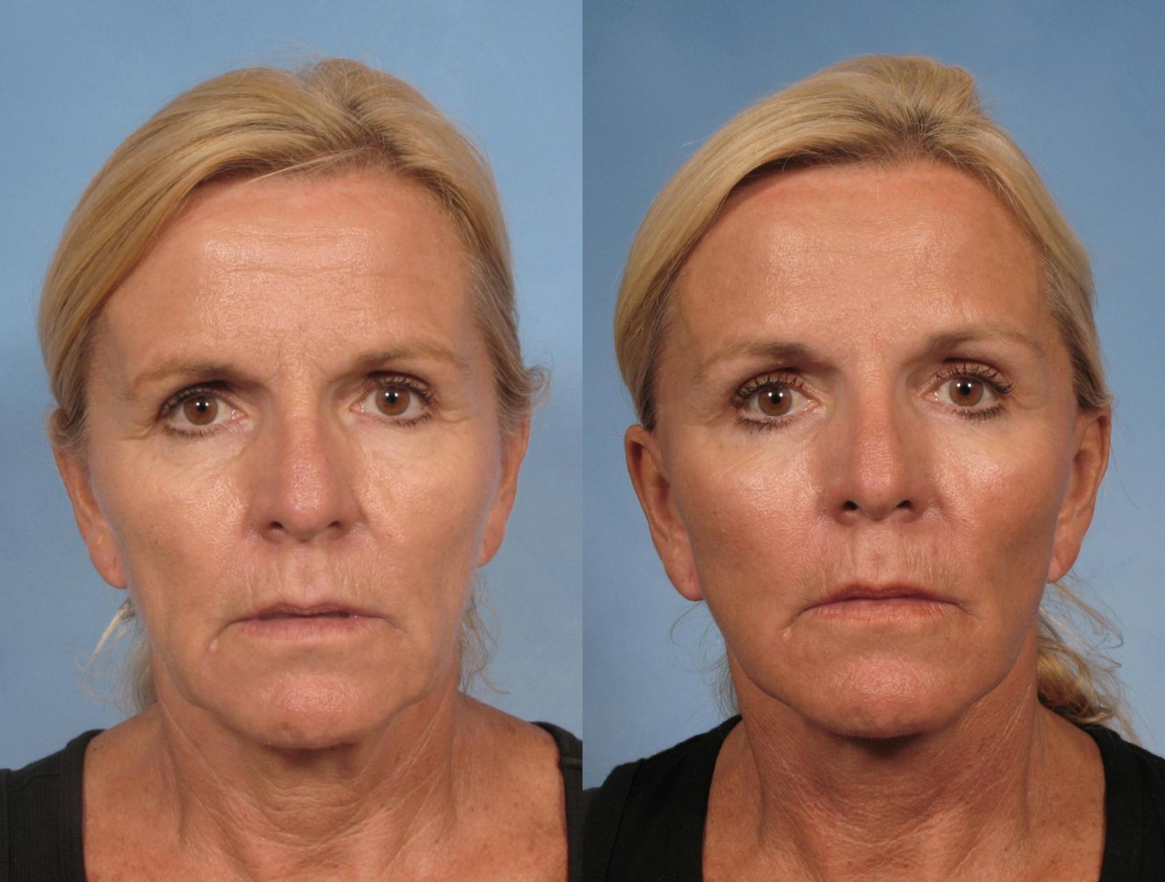 Before & After Eyelid Lift (Blepharoplasty) Case 106 View #1 View in Naples and Ft. Myers, FL